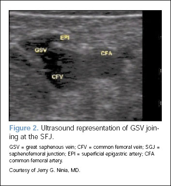 Fig-2 - Ultrasound representation of GSV joining at the SFJ.