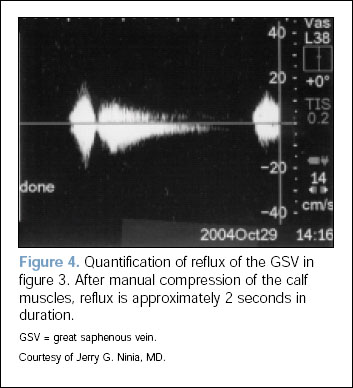 fig-4 - Quantification of reflux of the GSV in figure 3. After manual compression of the calf muscles, reflux is approximately 2 seconds in duration.